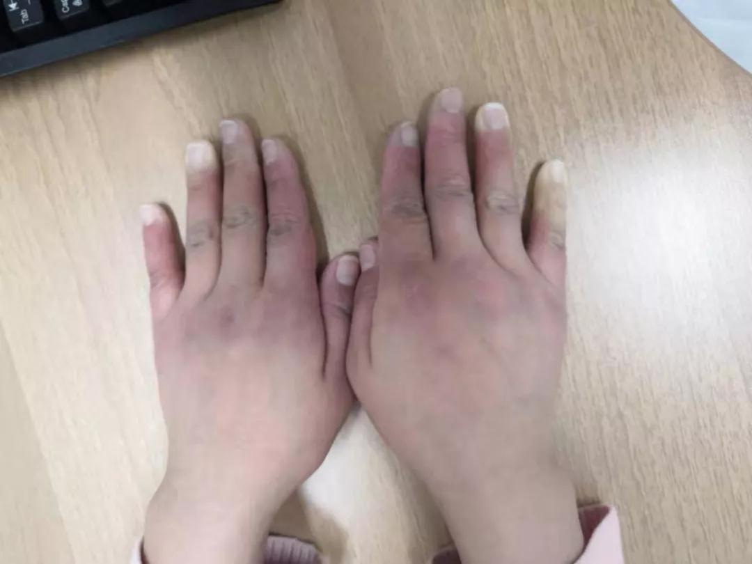 “手指、腳趾發(fā)白、發(fā)紫……”這些“小毛病”千萬別大意