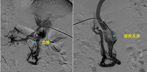 血栓攔路，如何破局——罕見巨大門靜脈血栓TIPS手術(shù)實錄