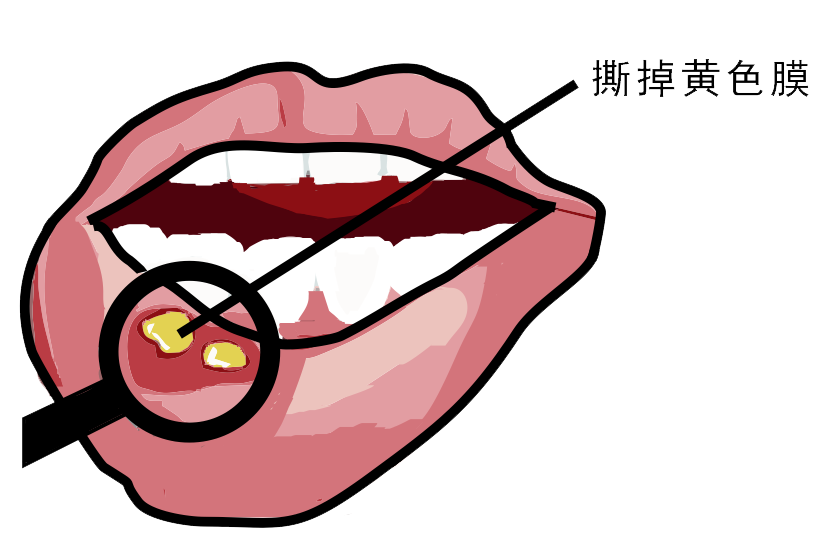 經(jīng)常口腔潰瘍，真的只是缺維生素嗎？