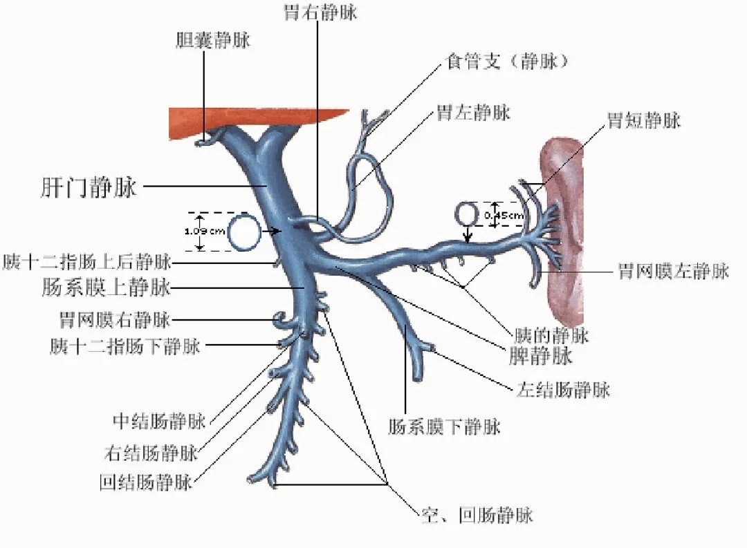 反復嘔血、黑便怎么辦？TIPS手術(shù)能解決