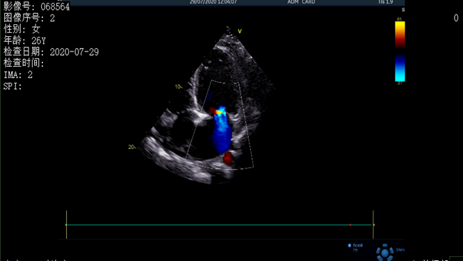 心電圖異常，心臟卻沒事，罪魁禍首是……