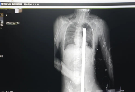 1.2米長的鋼筋貫穿男子胸腹！情況極度危險......