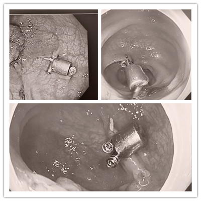 消化病醫(yī)院內(nèi)外科聯(lián)合開(kāi)展3例“磁環(huán)預(yù)標(biāo)記輔助腹腔鏡結(jié)、直腸癌根治術(shù)”